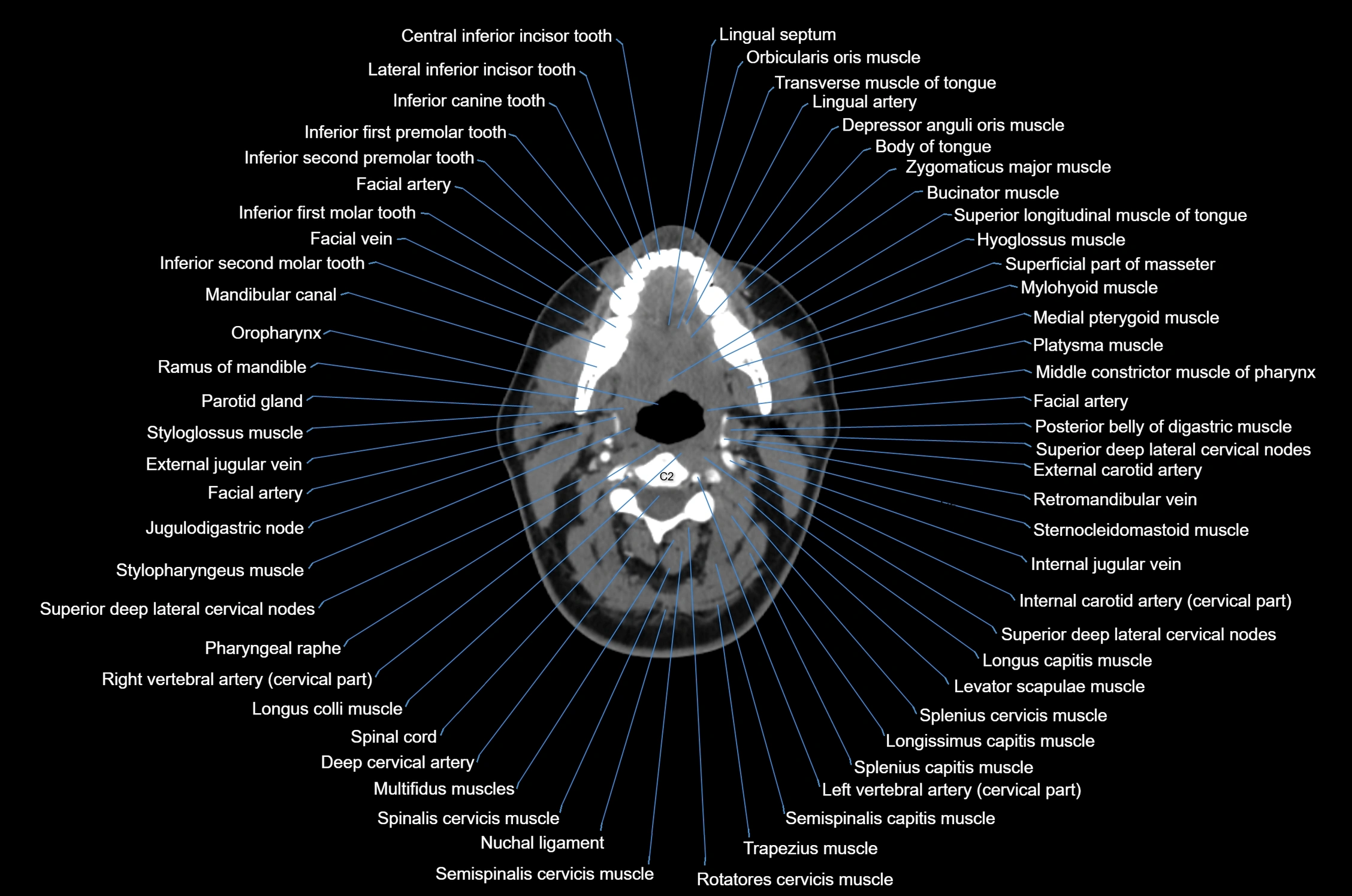 CT Neck axial cross sectional anatomy radiology image-img-00001-00030.webp